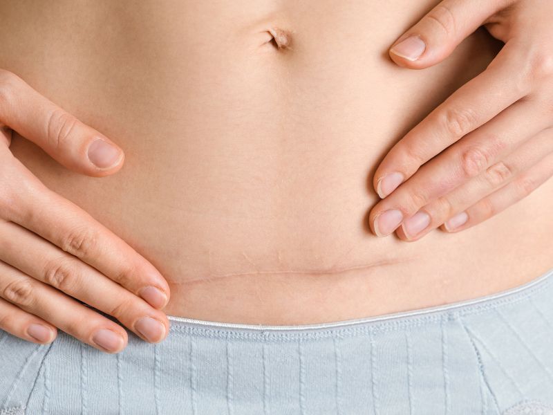 علائم پارگی بخیه سزارین از داخل