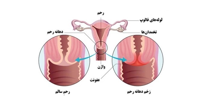 زخم دهانه رحم خطرناک است